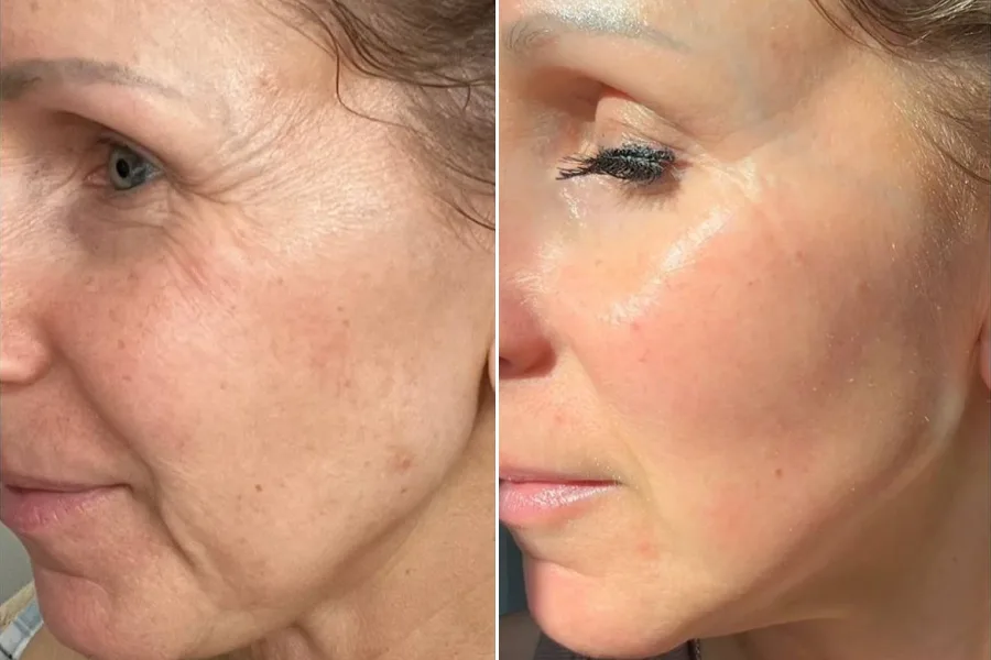 Thermage CPT Therapy