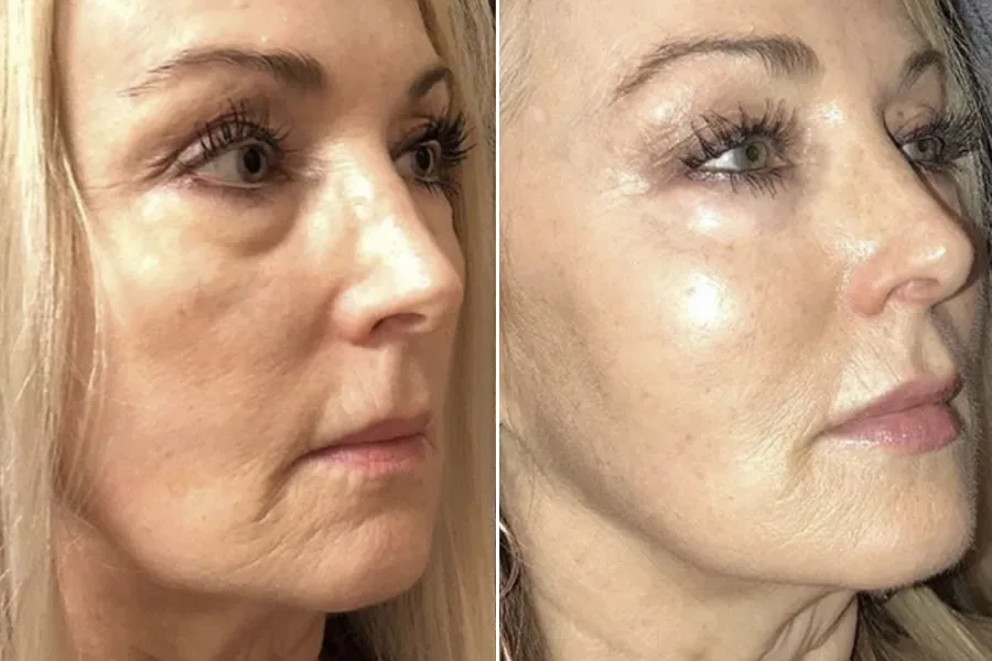 Thermage CPT Therapy