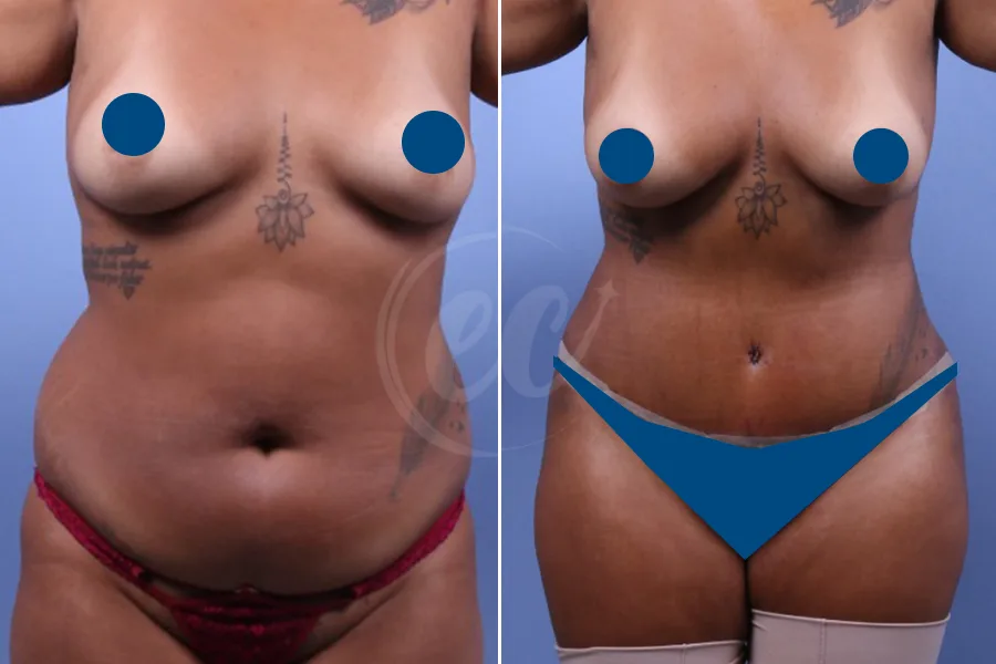 Tummy Tuck
