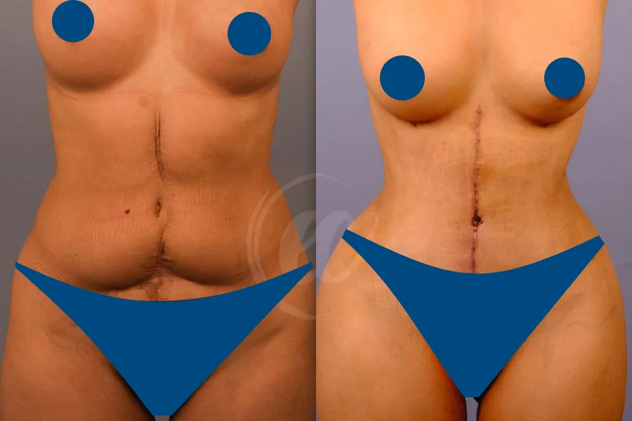 Tummy Tuck
