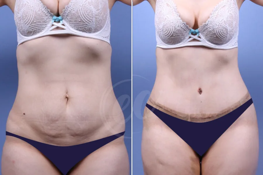 Tummy Tuck