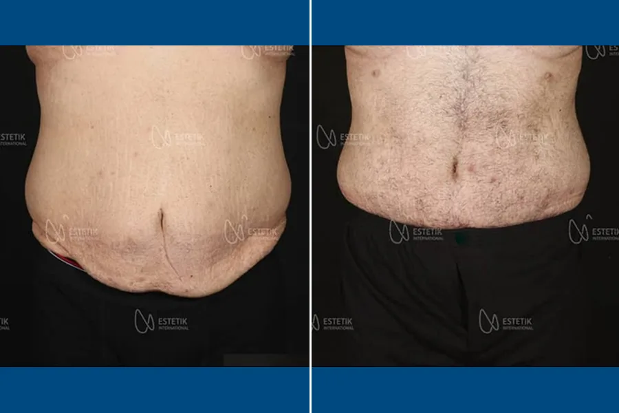Tummy Tuck