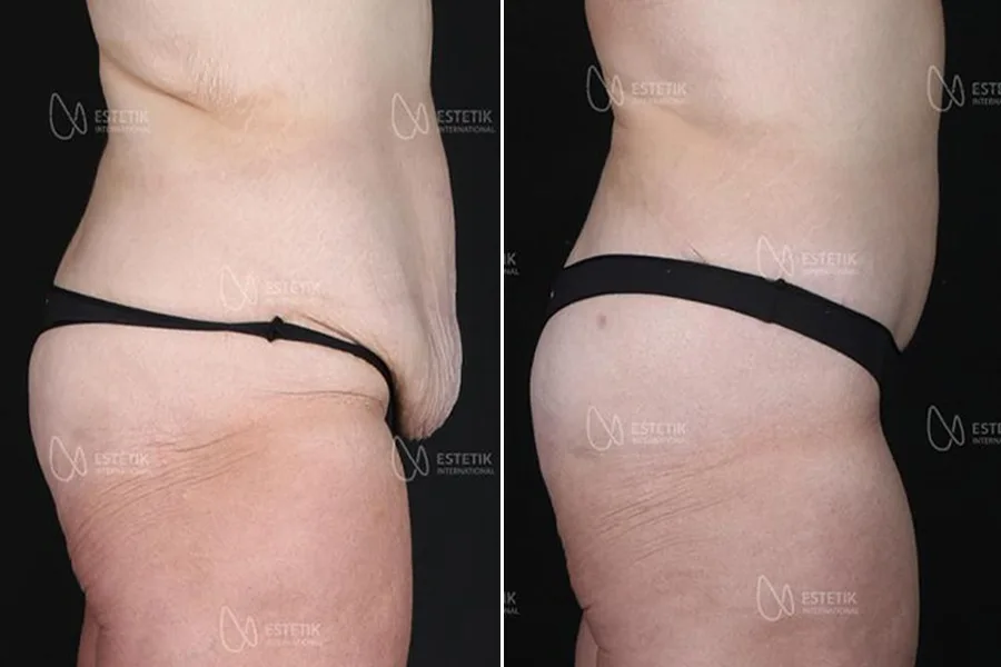 Tummy Tuck