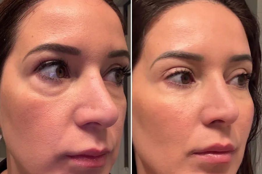 Under-Eye Light Filler