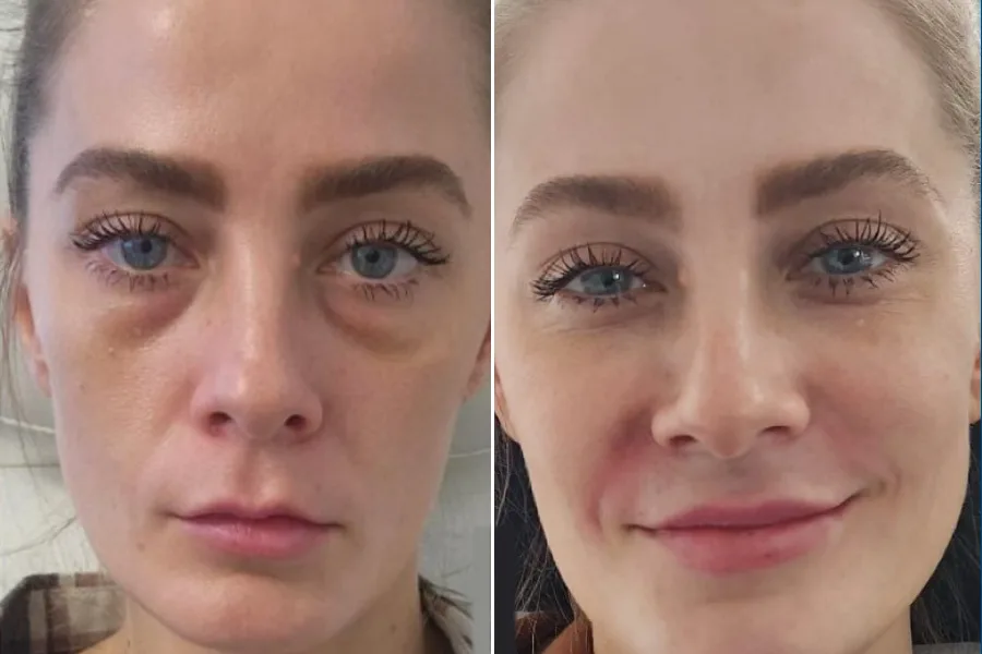 Under-Eye Light Filler