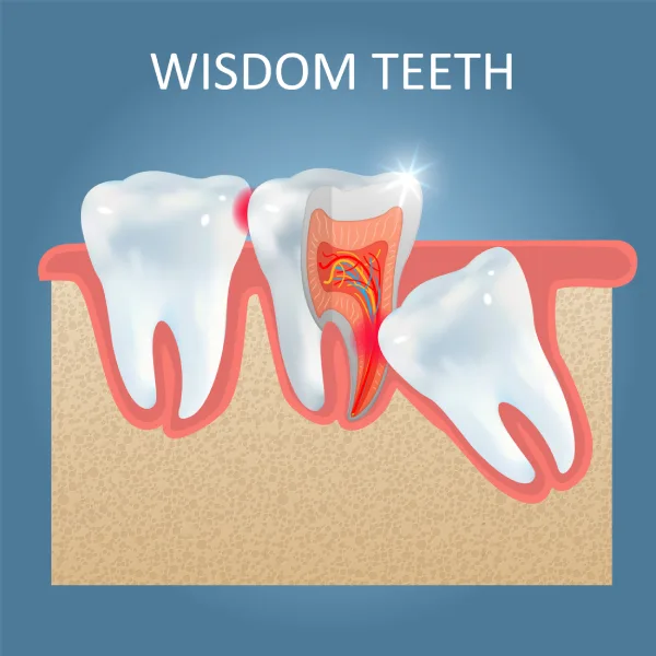 Wisdom Tooth Extraction
