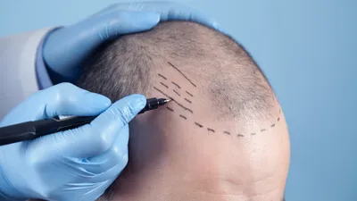 Body Hair Transplantation