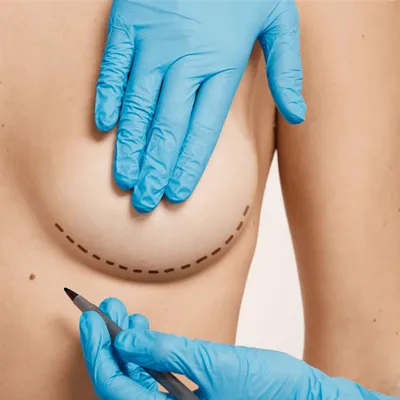 Breast Lift