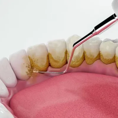 Dental Scaling (Tartar Removal)