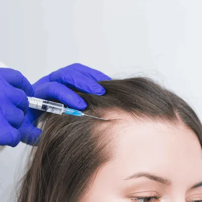 Female Hair Transplantation