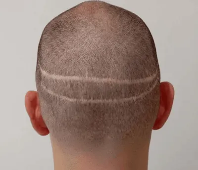 FUT Hair Transplantation