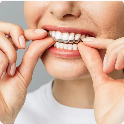 Invisalign Clear Aligners