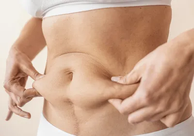 Liposuction