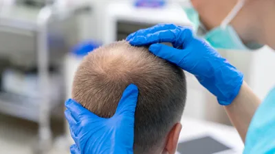 Long DHI Hair Transplantation