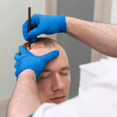No-Shave Hair Transplantation