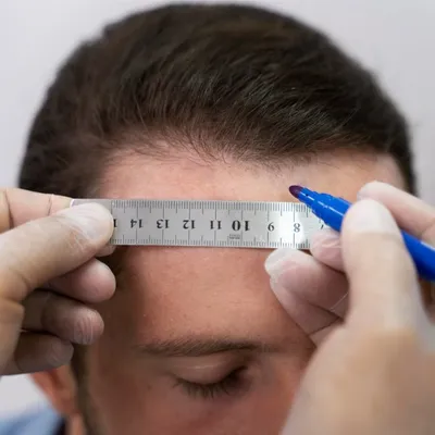 Revision Hair Transplantation