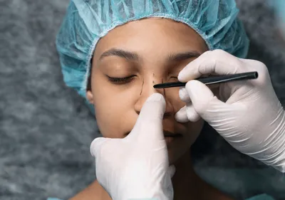 Revision Rhinoplasty