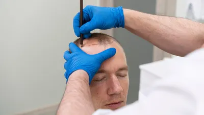 SDHI Hair Transplantation
