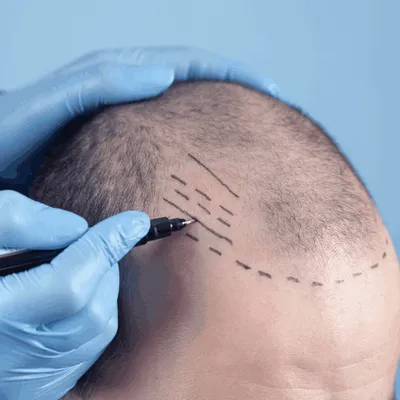 Shaven Hair Transplantation