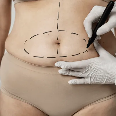 Tummy Tuck